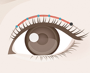 韓国式埋没法4点・6点留めのイメージ