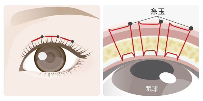 従来のポピュラーな二重術