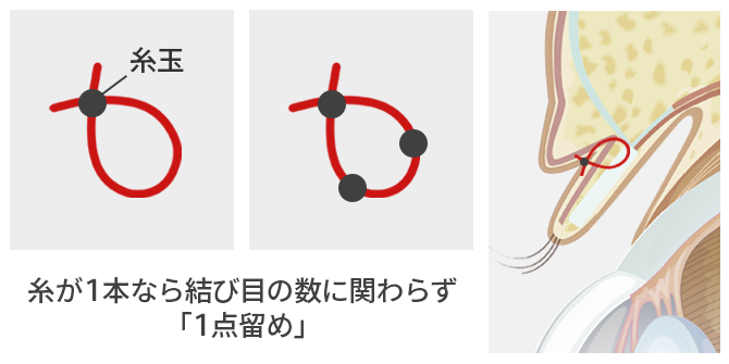 腫れにくく取れにくい特殊な二重術