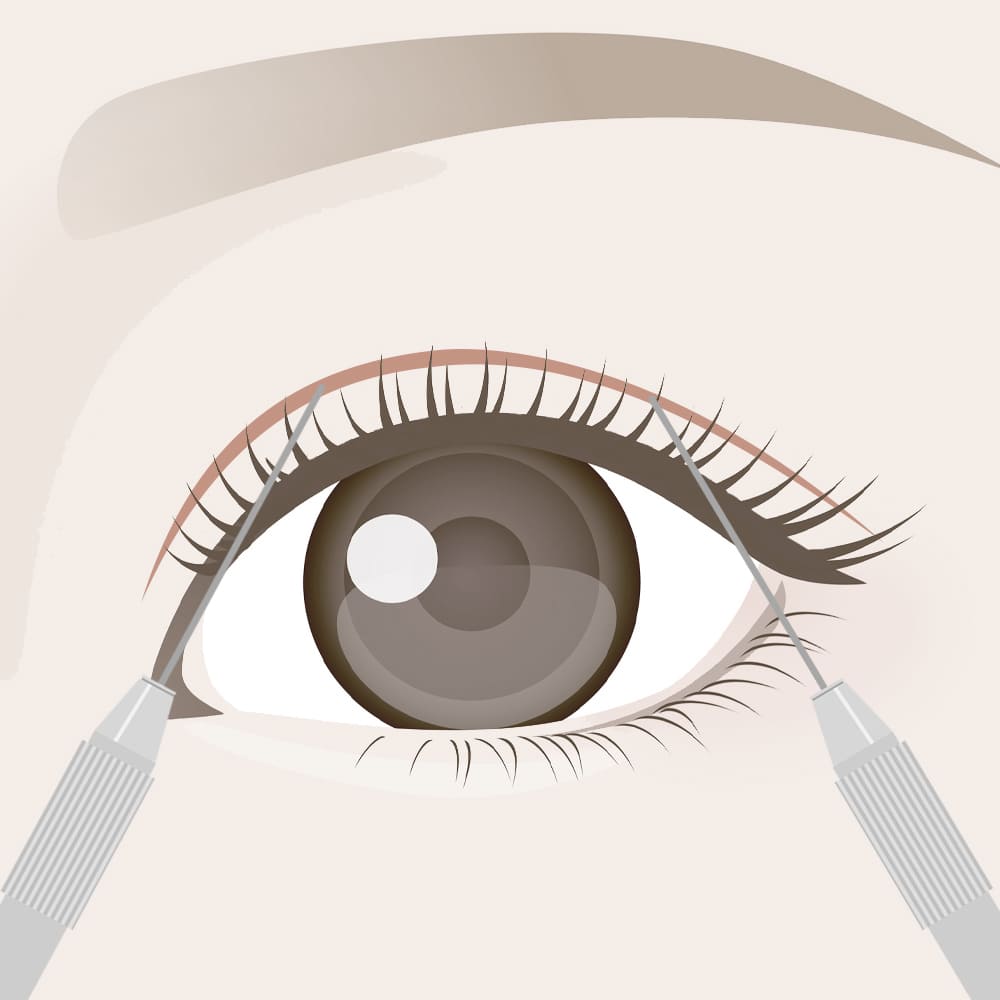 二重埋没法のデザイン