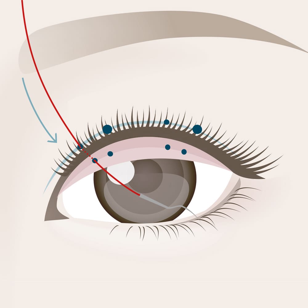 皮膚側から細い糸をまぶたの裏側へと通す