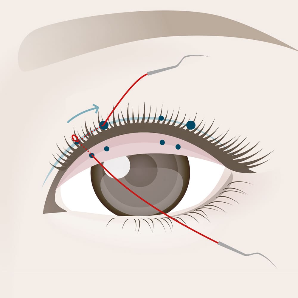 皮膚側の糸を皮膚の浅い部分を通す