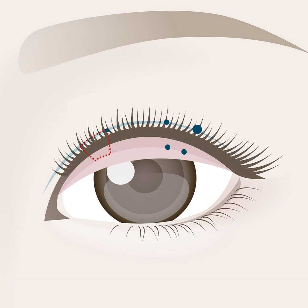 糸を結んで結び目を皮膚の中に埋め込む