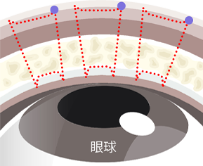 従来の3点留め