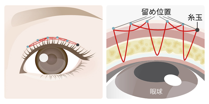 韓国式埋没法（4点・6点留め）