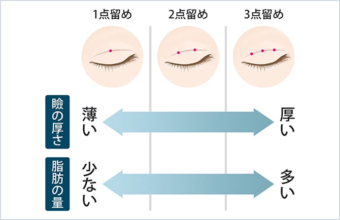 ジョウクリ式二重まぶた埋没法 美容整形外科のジョウクリニック ジョウクリ式二重まぶた埋没法 美容整形外科のジョウクリニック