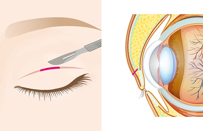 まぶたの切開と目の断面