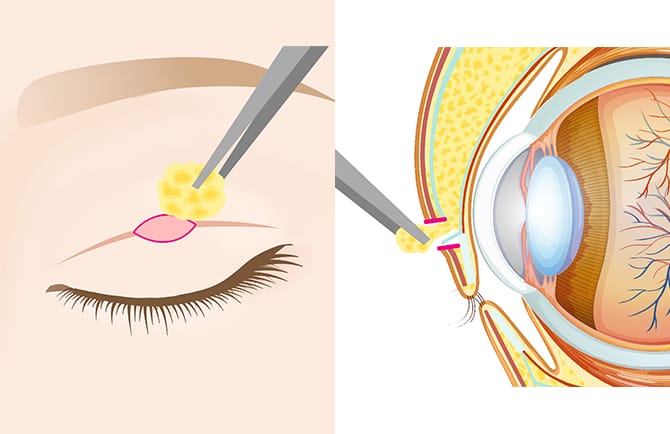 まぶたの脂肪除去と目の断面