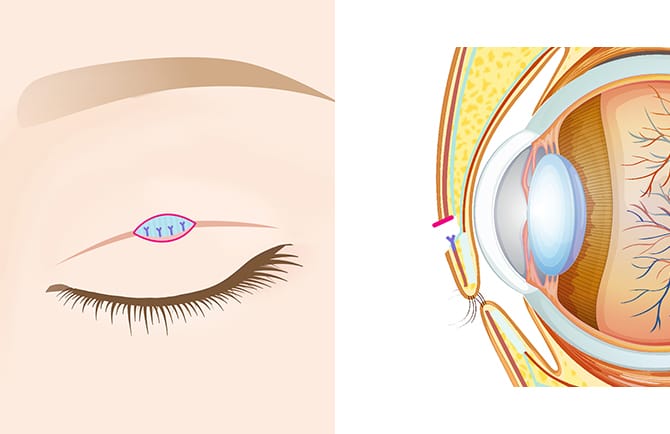 挙筋腱膜の固定