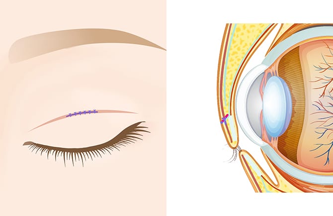 まぶたの切開部の縫合