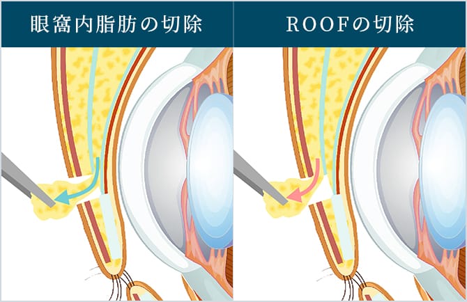 眼窩内脂肪の切除とROOFの切除の図