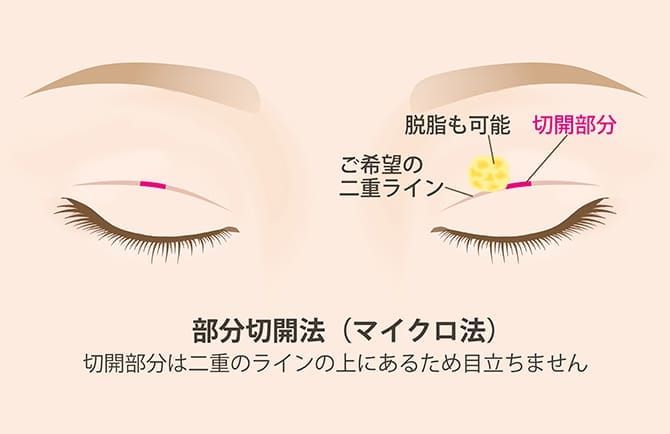 部分切開法(マイクロ法)