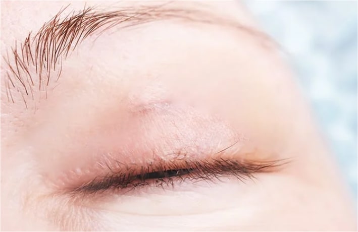 切開部分を最小限に抑えられる