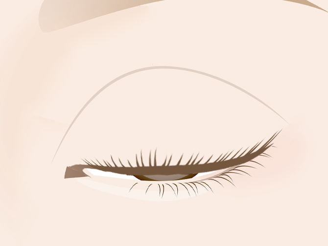 二重の食い込みが強い・目が閉じにくい