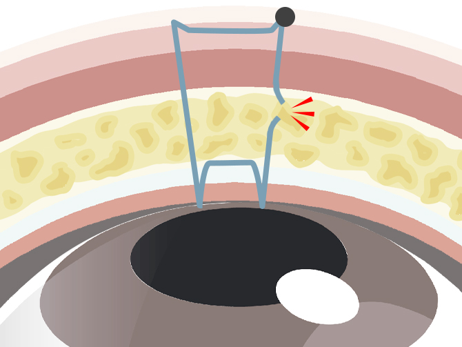 埋没法がすぐ取れた