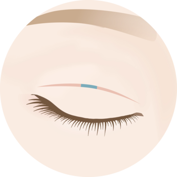 切開による再手術