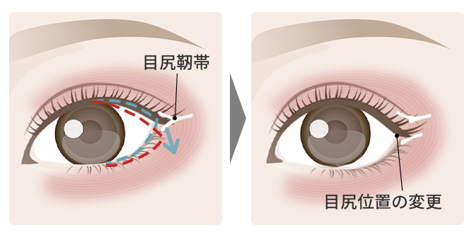 目尻靭帯移動術