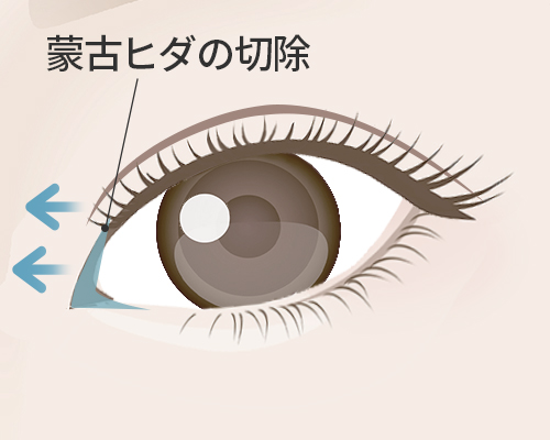 目頭切開法
