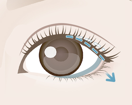 目尻靭帯移動術