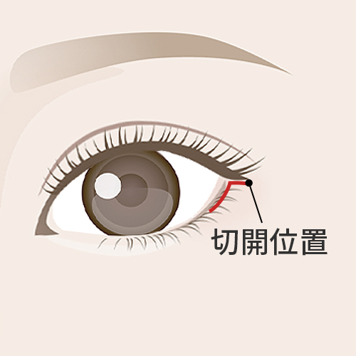 デザイン・切開