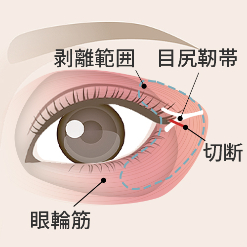 目尻靭帯の切断