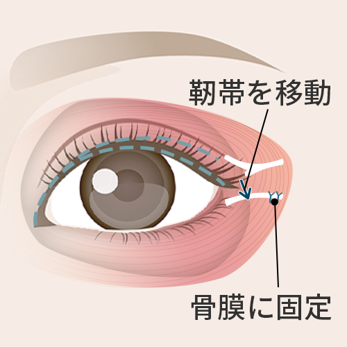 目尻靭帯を固定
