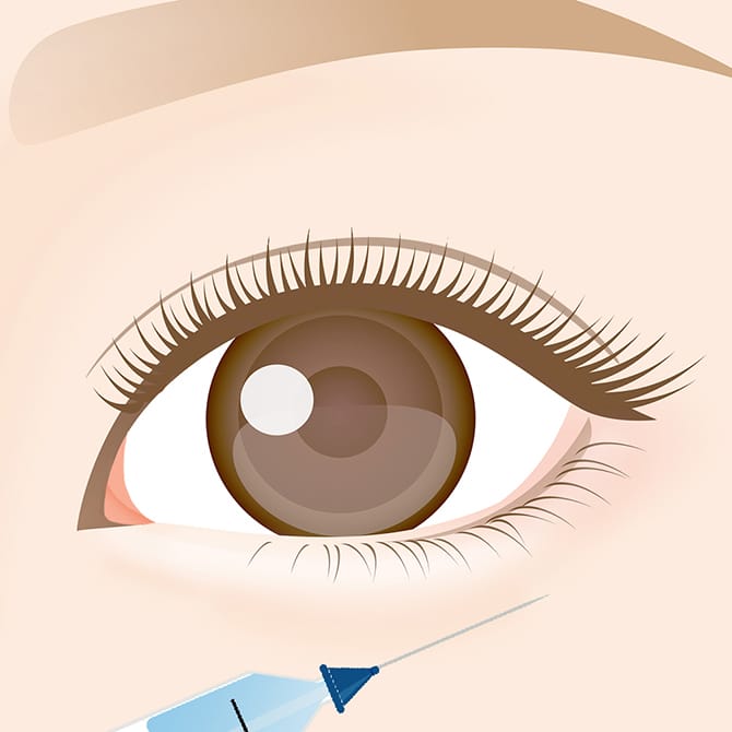 涙袋の中央に注入