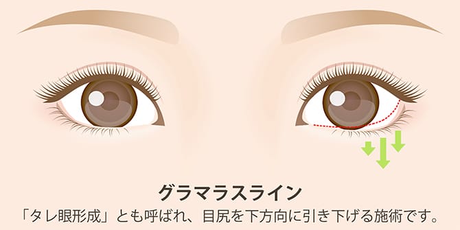 グラマラスライン(たれ目形成)