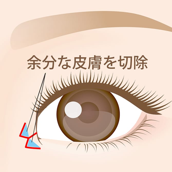W法の皮膚切除