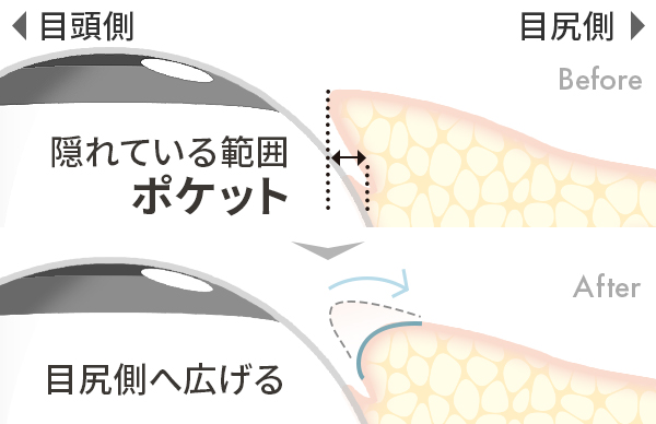 結膜のポケット