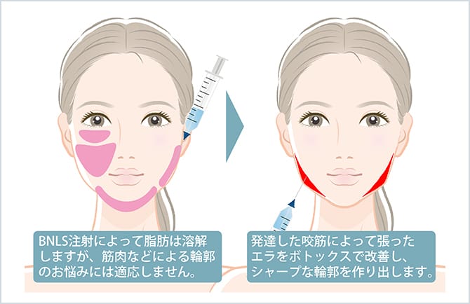 Bnls注射 脂肪溶解注射 による小顔形成 美容整形外科のジョウクリニック Bnls注射 脂肪溶解注射 による小顔形成 美容整形外科のジョウクリニック