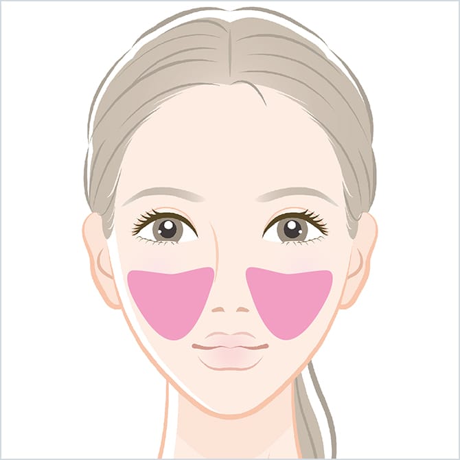 BNLS注射の頬の施術箇所の図