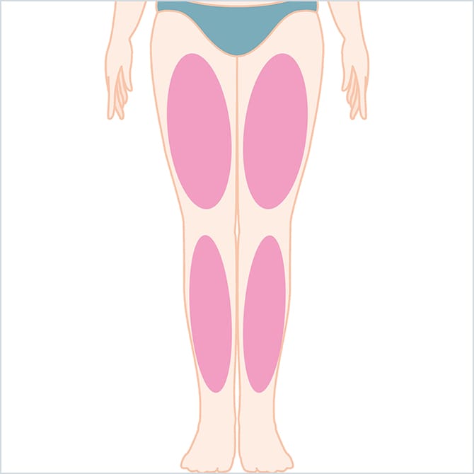 BNLS注射の太もも・下肢の施術箇所の図