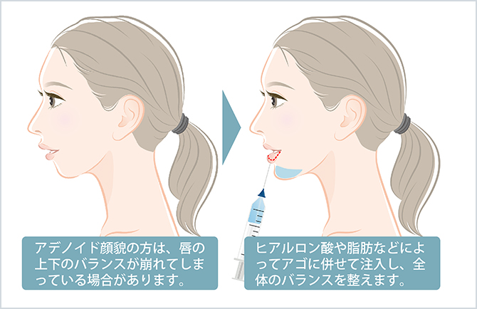 顎ヒアルロン酸注入 美容整形外科のジョウクリニック