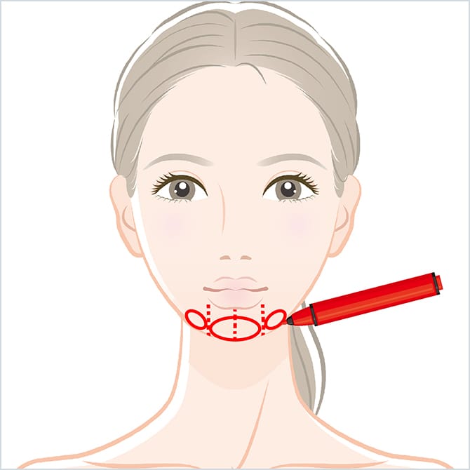 顎にマーキングする図