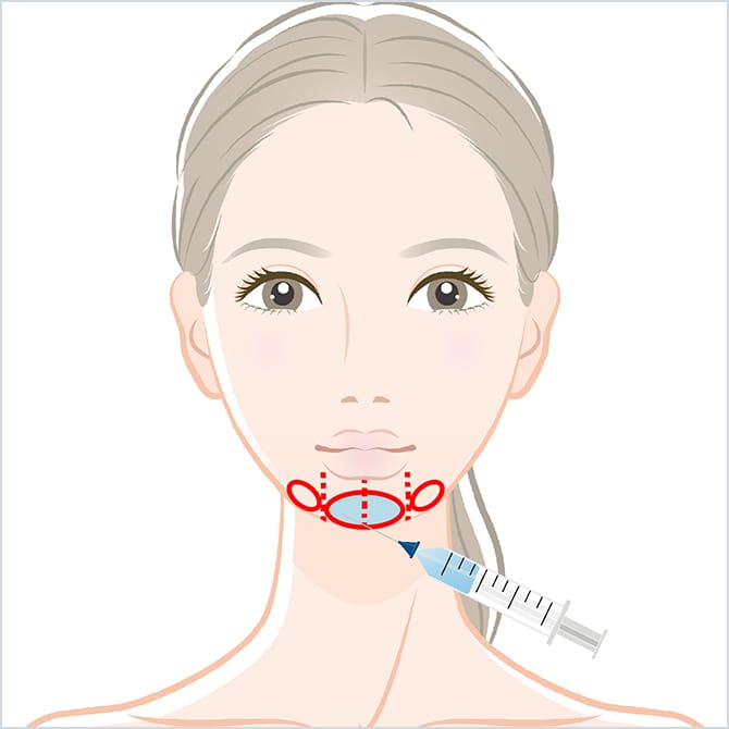 ヒアルロン酸注入
