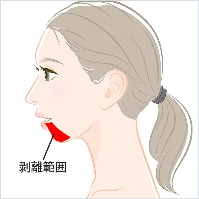 顎の剥離範囲