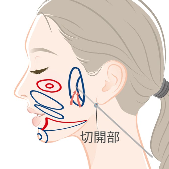 カニューレとプロテクターを使用して脂肪吸引するイメージ