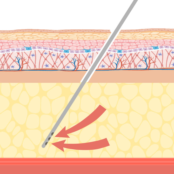 カニューレとプロテクターを使用して脂肪吸引するイメージ2