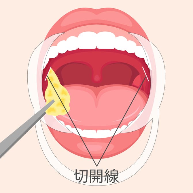 テーピングの無い鼻の図