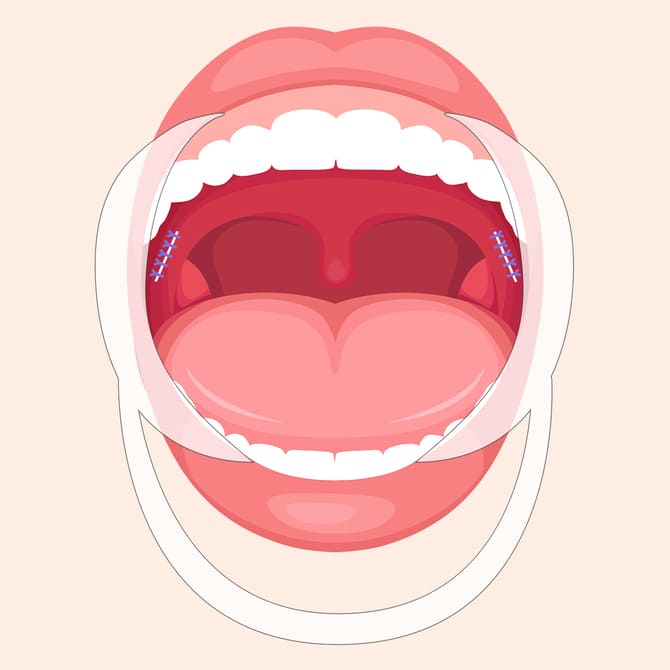 外側法のテーピングイメージ