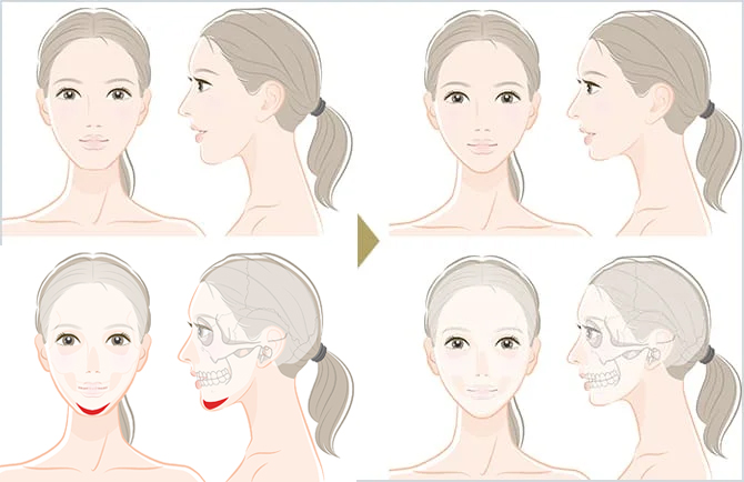 オトガイ(顎)削りとは