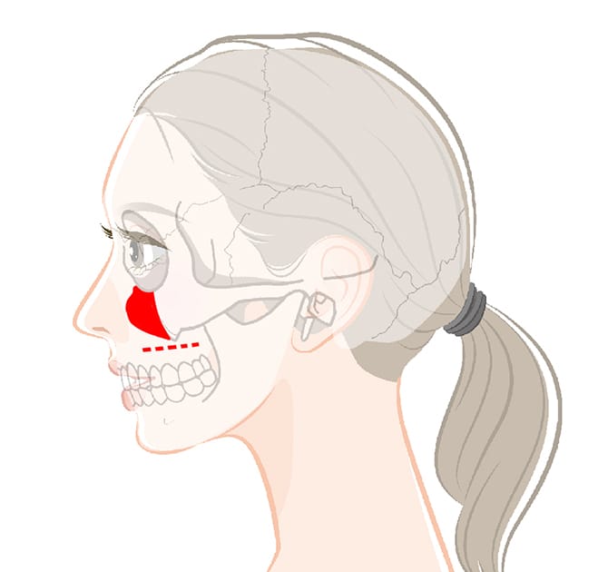 頬体部骨を削る