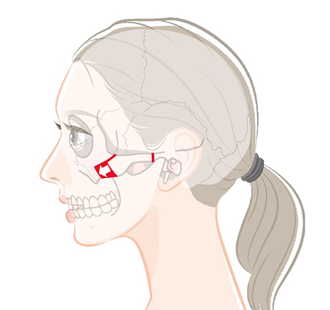 頬骨弓をずらして固定