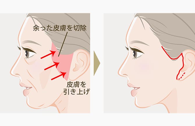 皮膚・脂肪のたるみは他の施術と併用して対策