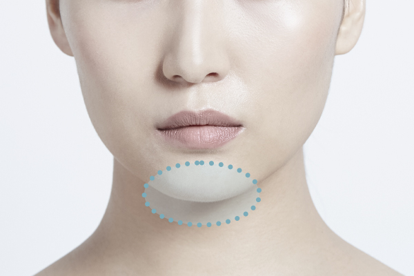 オトガイ(顎)骨切り・骨削り術