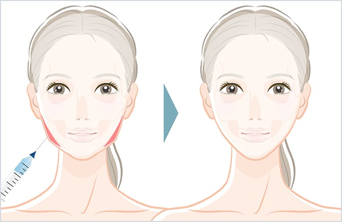 ボツリヌストキシン注射