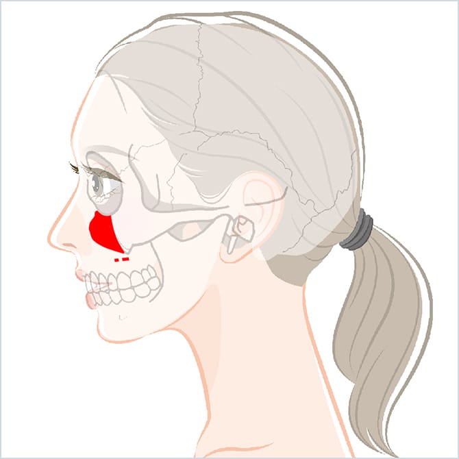 頬体部骨を削る