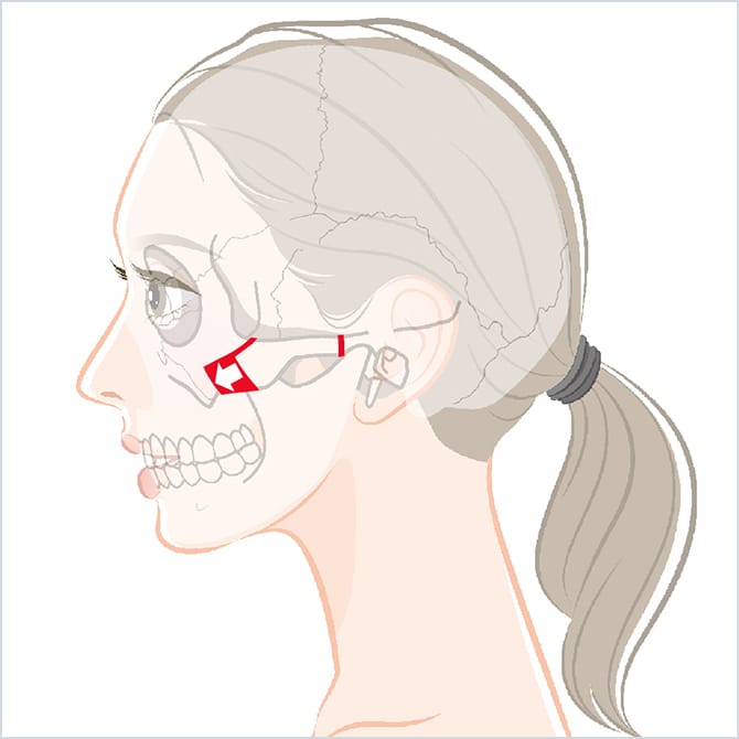 頬骨弓をずらして固定する