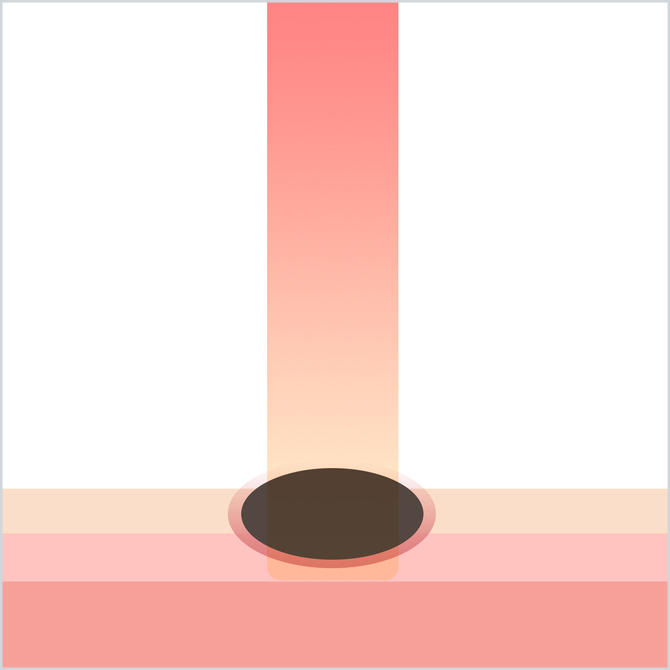 電気メスでほくろを焼くイラスト